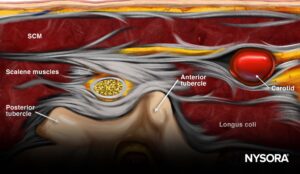 3. Fig. 6 - TechniqueCervical Nerve Root Block1 (2) (1) - NYSORA | NYSORA