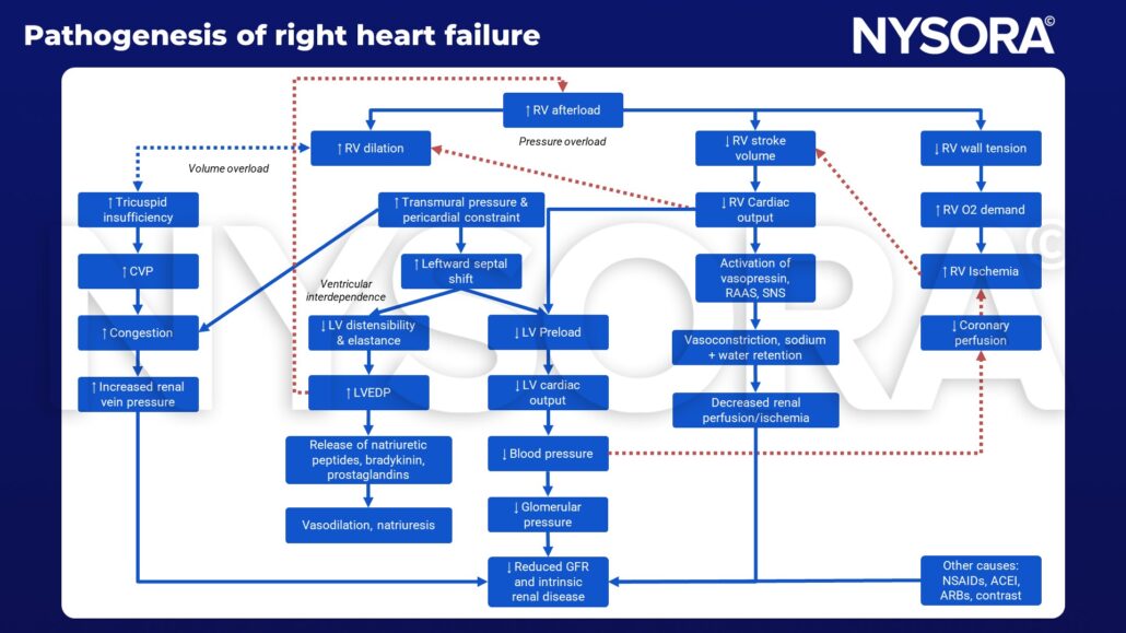 RV, tricuspid insufficiency, CVP, congestion, increased renal vein pressure, leftward septal shift, LVEDP, natriuretic peptides, blood pressure, glomerular pressure, vasodilation, stroke volume, cardiac output, RAAS, vasopressin, SNS, vasoconstriction, sodium and water restriction, renal perfusion, ischemia