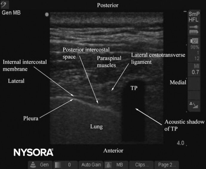 Tips for the Thoracic Paravertebral Block (Transverse Scan) - NYSORA ...