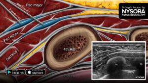 Tips for a PEC II Block - NYSORA | NYSORA