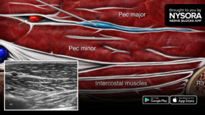 Tips for a PEC I Block - NYSORA