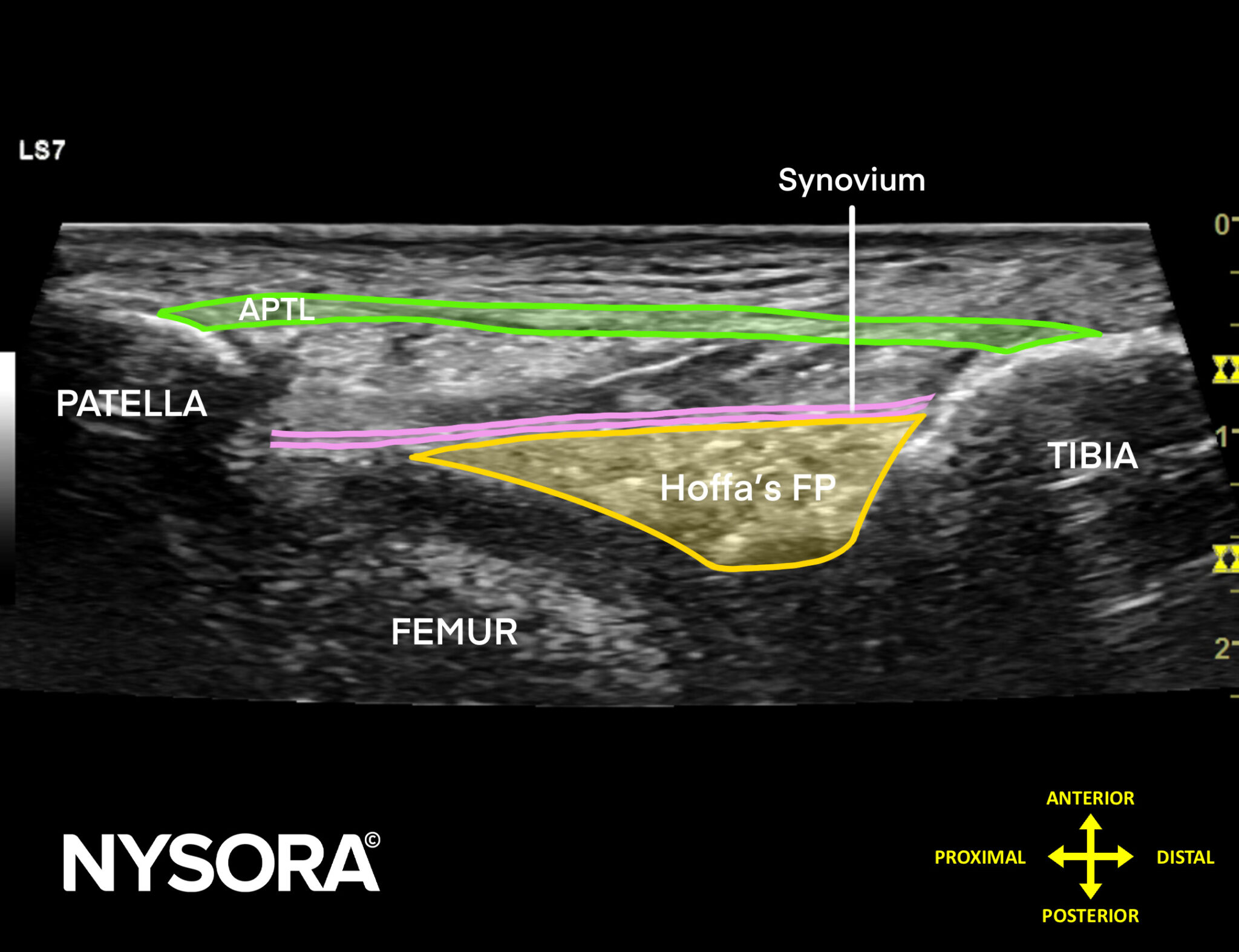 2.1 Patellotibial_Ligament_Slider copy - NYSORA | NYSORA