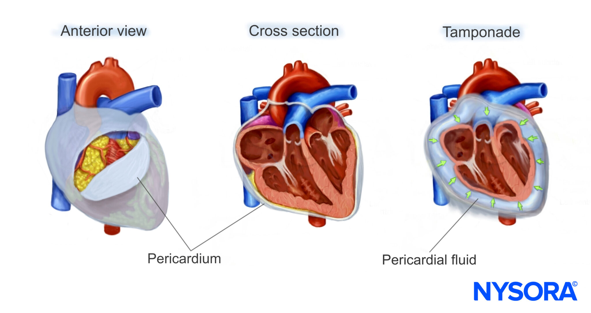 Identifying Pericardial Effusion or Tamponade: A Guide to Ultrasound ...