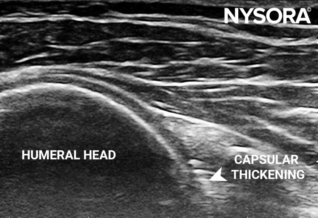 Case Study Adhesive Capsulitis Injection NYSORA NYSORA