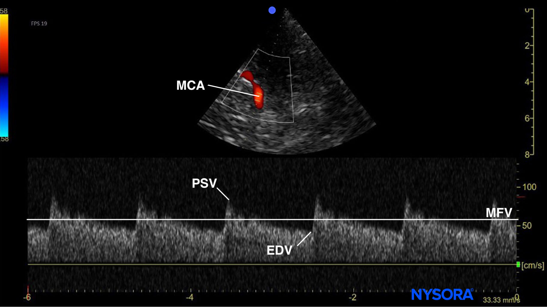 Evaluación Del Vasoespasmo Cerebral Con Doppler Transcraneal Una Guía