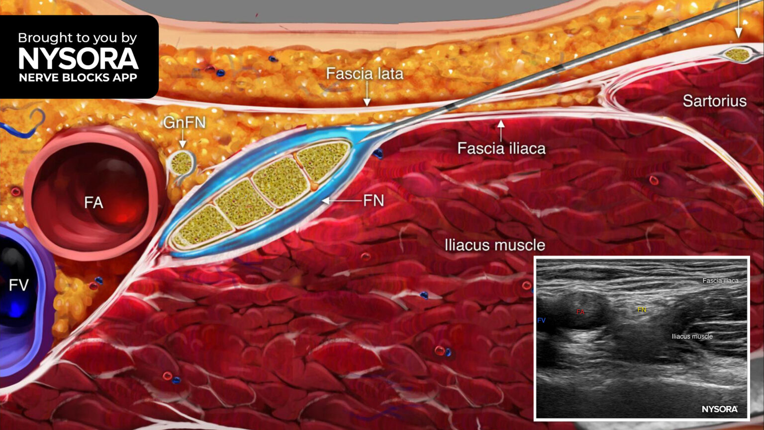 Tips For A Femoral Nerve Block - NYSORA | NYSORA