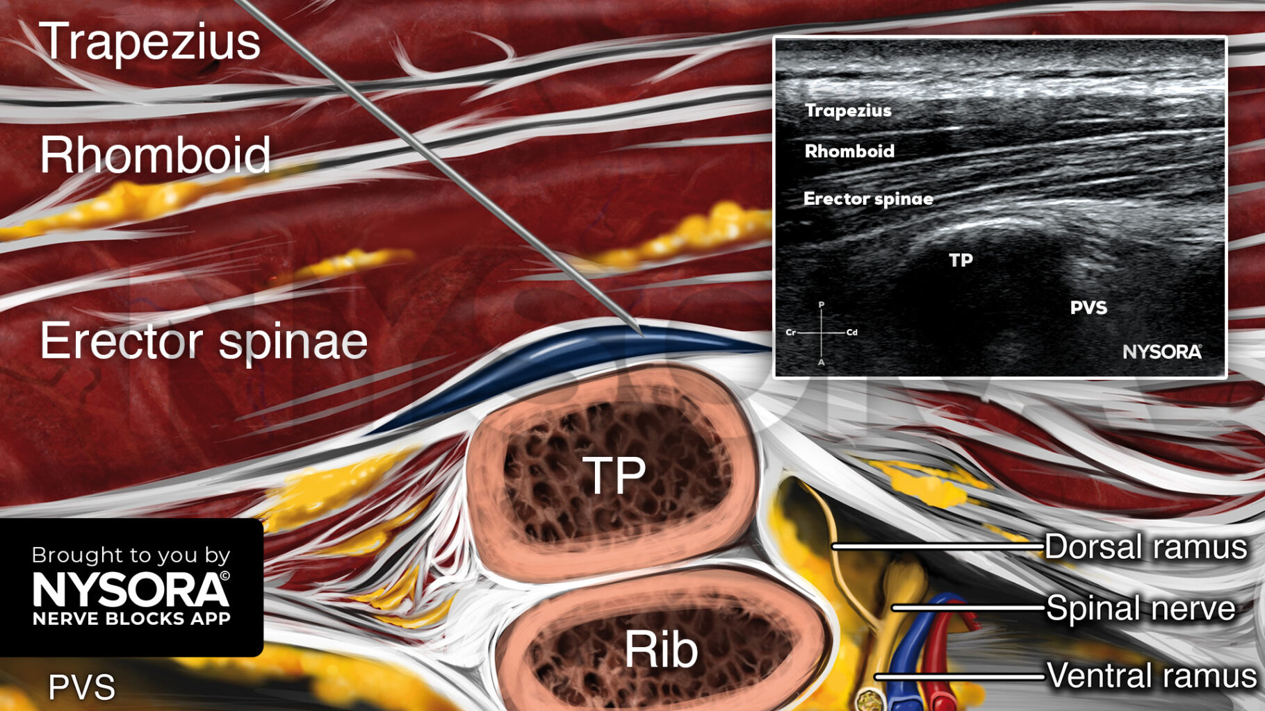 Nov 7 - NEWS _ Erector spinae - NYSORA