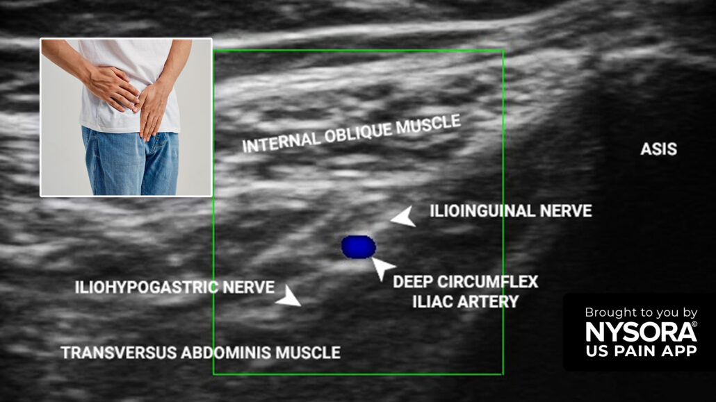 Case study: Ilioinguinal neuralgia - Injection - NYSORA