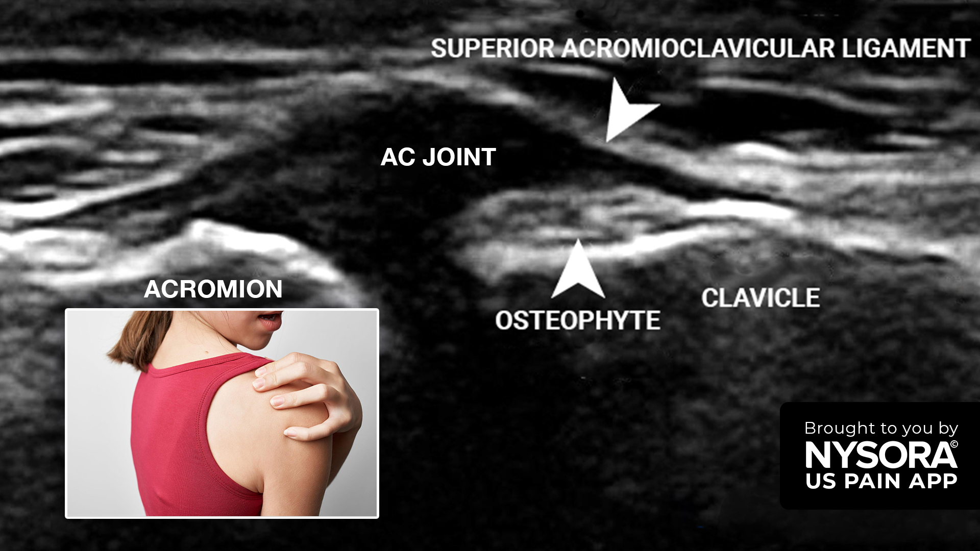 Case study: Acromioclavicular joint arthritis - Injection - NYSORA