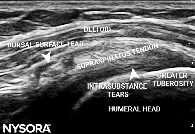 Case Study: Subacromial Impingement Syndrome - Injection - NYSORA