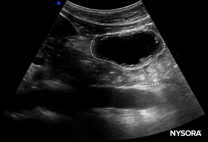Gastric ultrasound study identifies key metrics