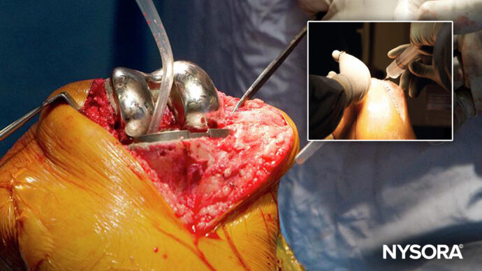 The role of periarticular injections in total knee arthroplasty: Insights from a recent study