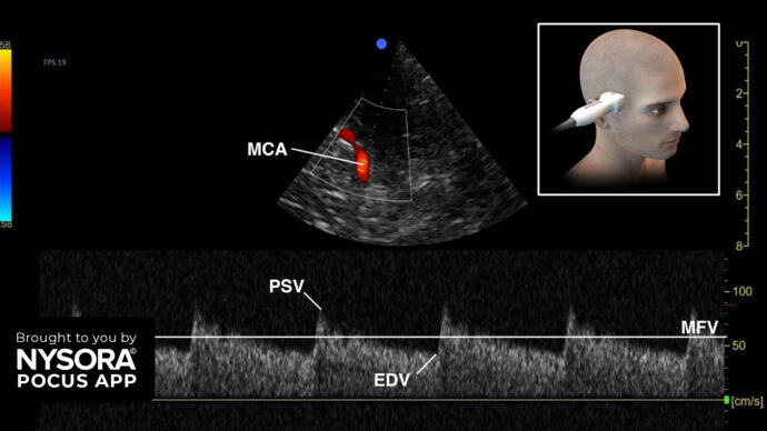 Case study: Detecting intracranial hypertension using transcranial doppler ultrasound