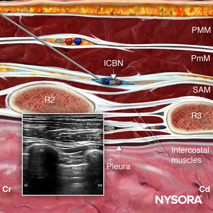 Just added: Intercostobrachial Nerve Block technique now available in the NYSORA Nerve Blocks App