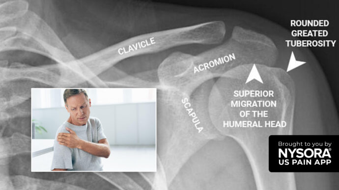 Case study:The SHAC technique for treating adhesive capsulitis