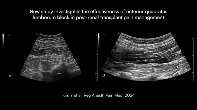 New study investigates the effectiveness of anterior quadratus lumborum block in post-renal transplant pain management