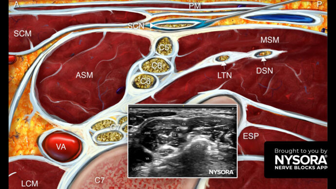 Introducing the Supraclavicular Nerves Selective Block on the NYSORA Nerve Blocks App