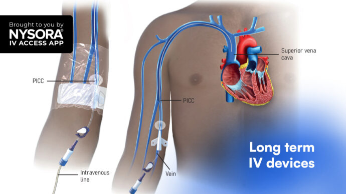 Understanding long-term intravenous devices