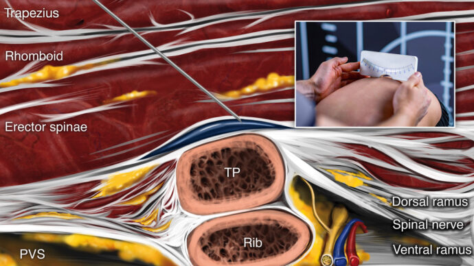 Assessing erector spinae plane blocks for improved recovery in adolescent spinal fusion surgery