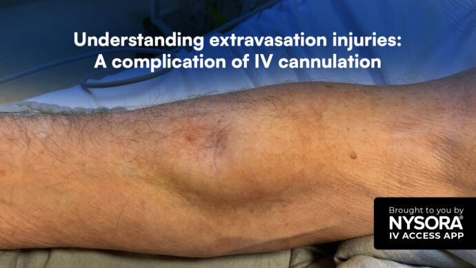 Understanding extravasation injuries: A complication of IV cannulation