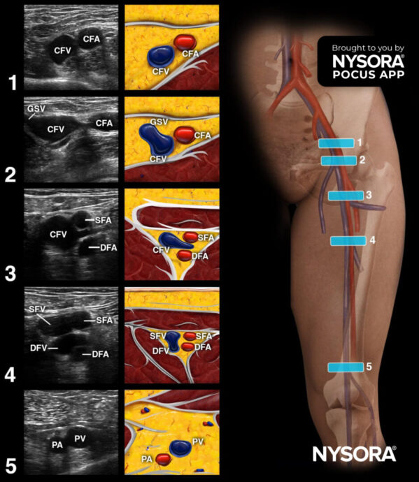 Detecting and managing deep venous thrombosis (DVT): A case study and best practices