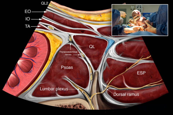 Comparing posterior quadratus lumborum block and intrathecal morphine for pain relief after scheduled cesarean section