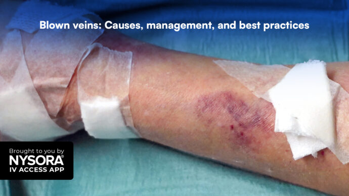 Blown veins: Causes, management, and best practices