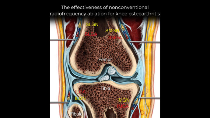 The effectiveness of nonconventional radiofrequency ablation for knee osteoarthritis