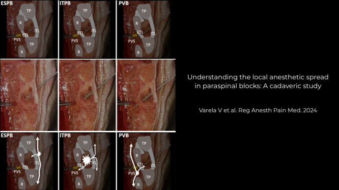 Understanding the local anesthetic spread in paraspinal blocks: A cadaveric study