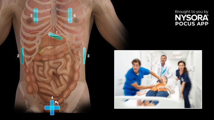 eFAST: A valuable tool in trauma diagnosis