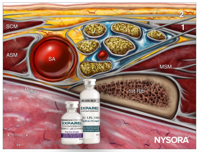 Evaluating the effect of liposomal bupivacaine in supraclavicular brachial plexus block