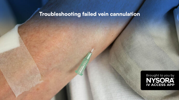 Troubleshooting failed vein cannulation: Effective strategies for clinicians