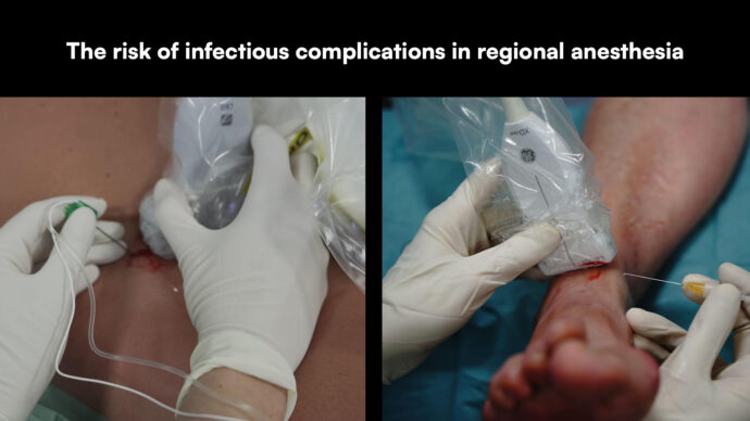 The risk of infectious complications in regional anesthesia