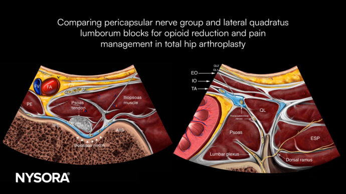 Comparing pericapsular nerve group and lateral quadratus lumborum blocks for opioid reduction and pain management in total hip arthroplasty