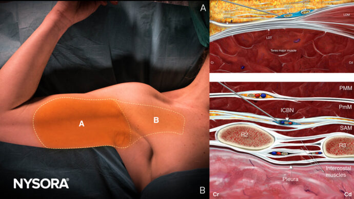 Comparing proximal and distal approaches for intercostobrachial nerve block in upper arm surgery