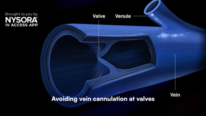 Avoiding vein cannulation at valves