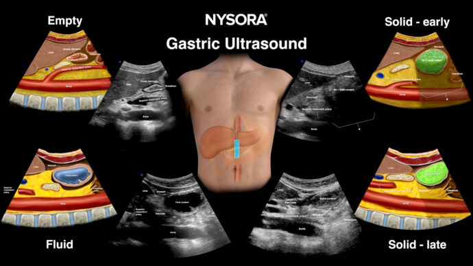 Evaluating Preoperative Gastric Ultrasound in Diabetic Patients with Dysautonomia