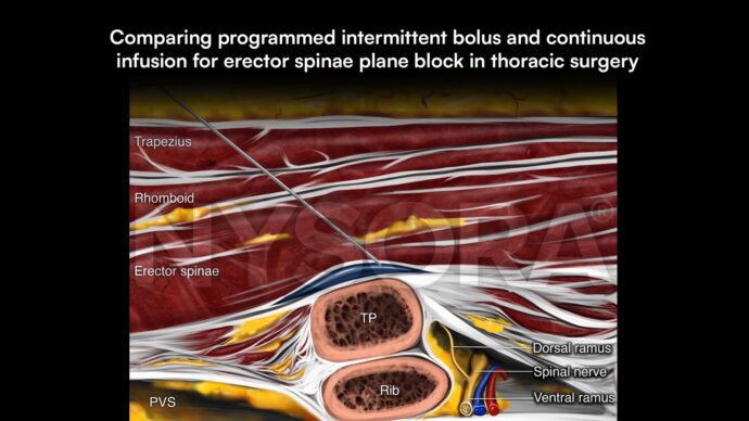 Comparing programmed intermittent bolus and continuous infusion for erector spinae plane block in thoracic surgery