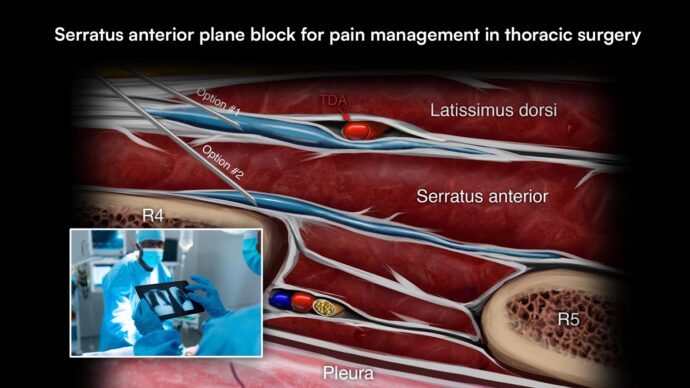 Serratus anterior plane block for pain management in thoracic surgery