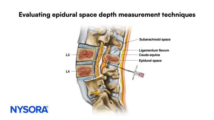 Evaluating Epidural Space Depth Measurement Techniques