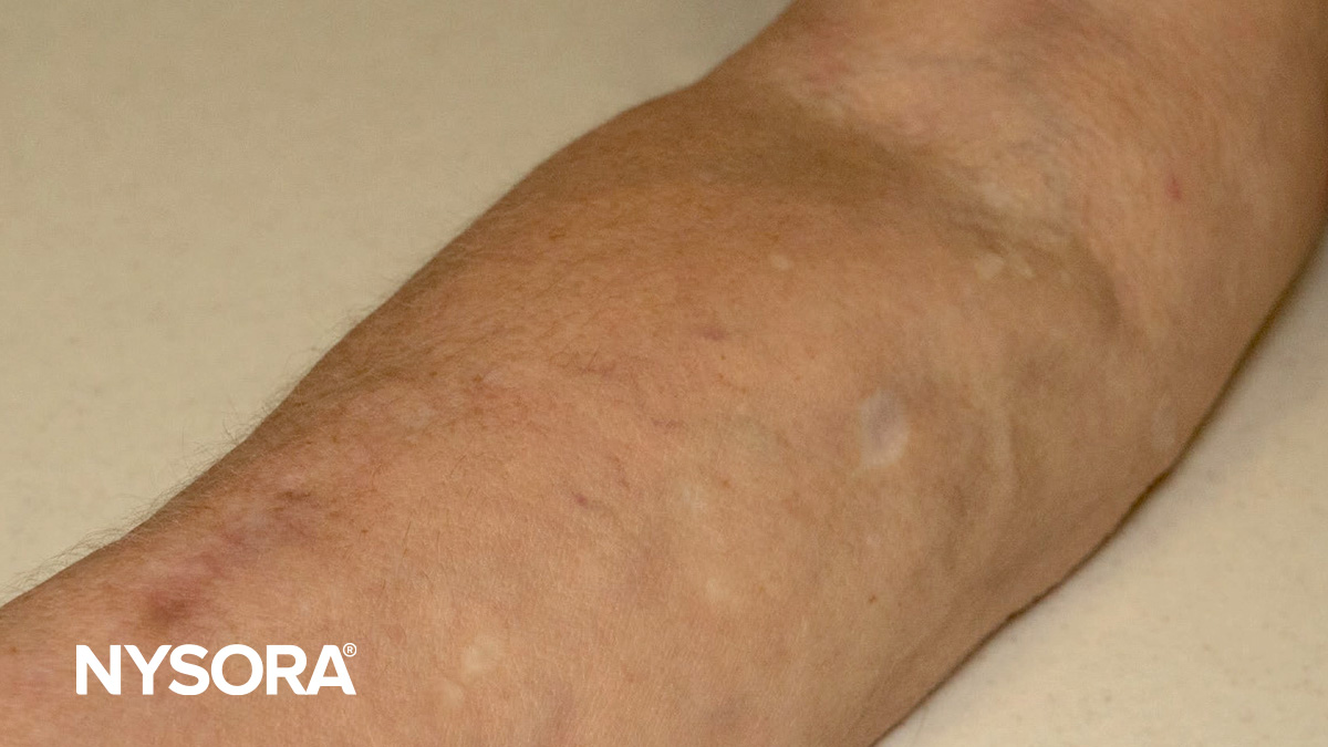 IV access in patients with a history of IV drug use