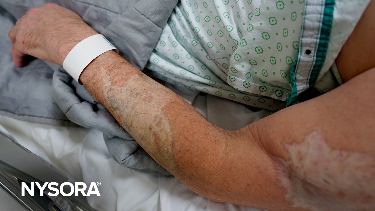 IV access in patients with burns