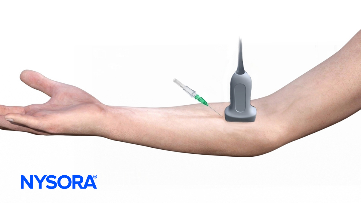 Transducer-needle orientation for US-guided IV access