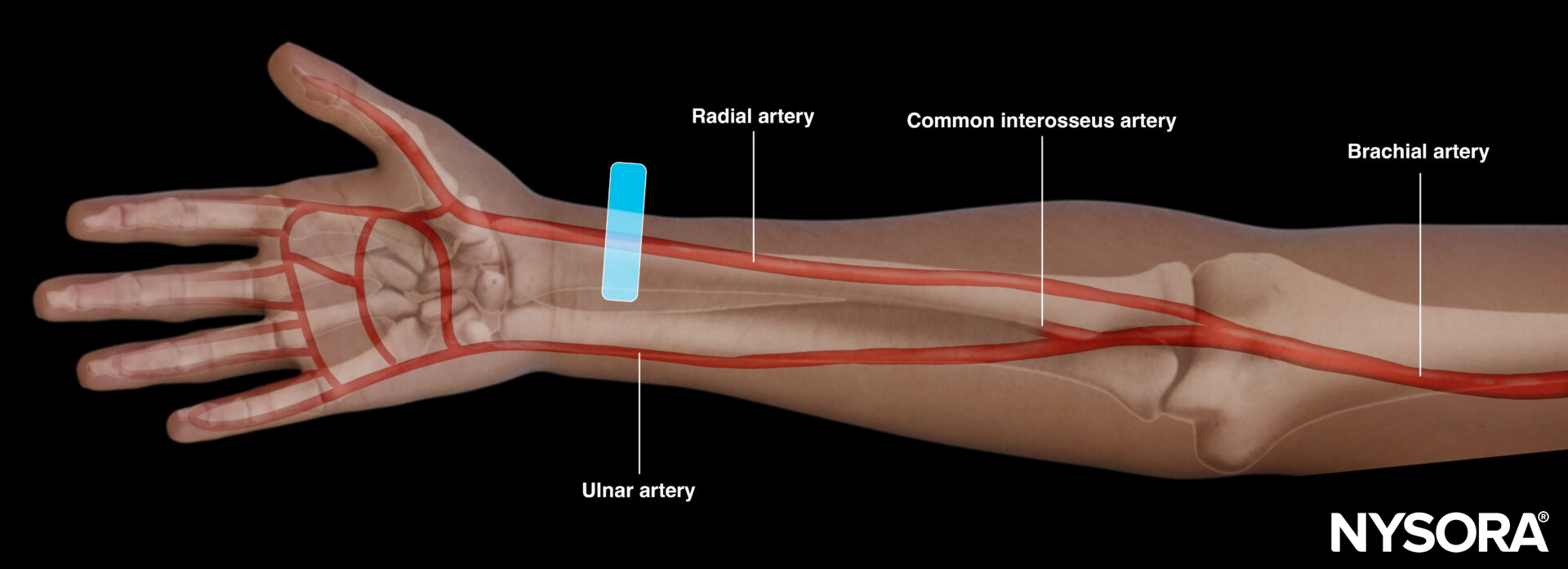 Radial artery cannulation