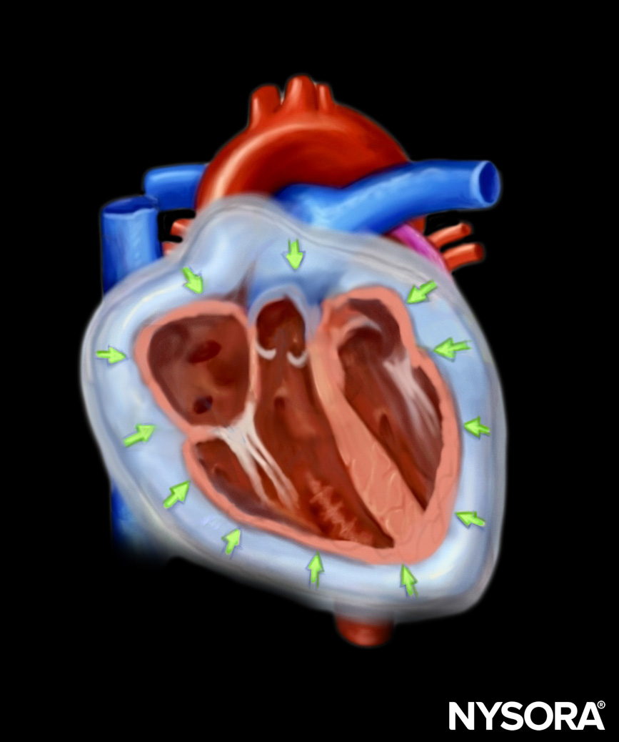Pericardial effusion – tamponade
